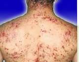 man's back covered in acne