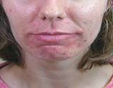 acne on woman chin