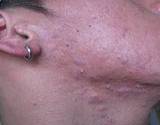acne on boys neck