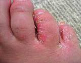 photo of a woman's foot suffering from athlete's foot fungus