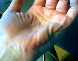 photo of a hand suffering from a muscle pain cramp