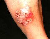 A photo of severe case of psoriasis on leg