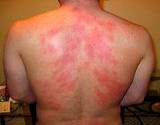 photo of a man with a severe skin rash on his back