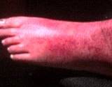 photo of a woman's foot with severe skin rash from a reaction to the drug 