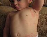 photo of a baby with a skin rash on its left side