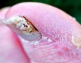 photo of a man's big toes with severe toenail fungus