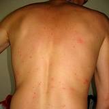 photo of a man's back covered with bed bug bites