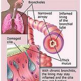 photo of a bronchitis chart a form of bacterial infections