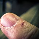 photo of a finger with a small cut an easy way for bacterial infections to enter the body