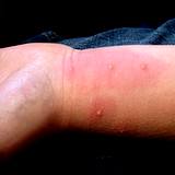 photo of fire ant bites on a forearm