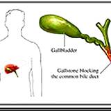a chart of the gallbladder and gallstone