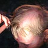 photo of scalp with bald spots, natural hair loss remedies needed here