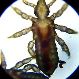 a photo of head lice