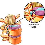 photo of a chart of healthy disc and herniated disc
