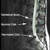 photo of chart of close-up of herniated disk
