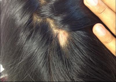 pimple on scalp
