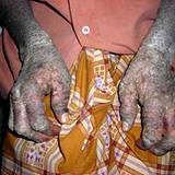 A photo of severe case of psoriasis on hands of African American