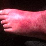 photo of a woman's foot with severe skin rash from a reaction to the drug 