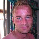 photo of a man with severely sunburned face in need of natural sunburn relief