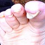 a photo of a foot with toenail fungus