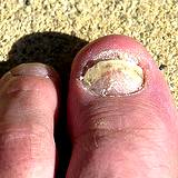 photo of foot in sand with toenail fungus